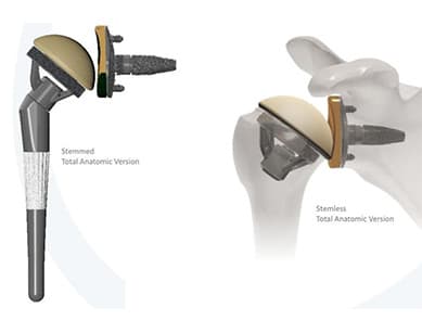 Total Shoulder Replacement