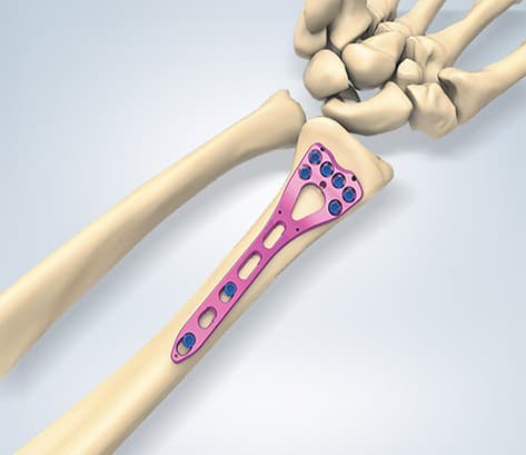 Valp – Distal Radius System