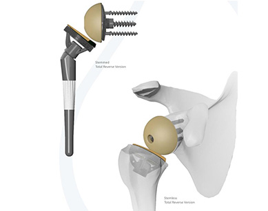 Reverse Shoulder Replacement