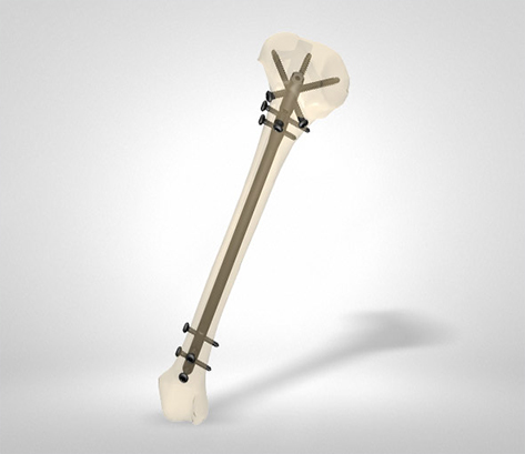 ML-Tibia Nail