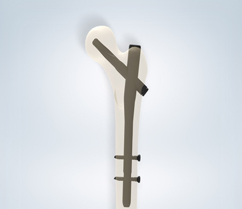 PFAN System