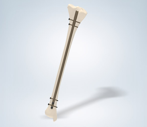SL-Tibia Nail